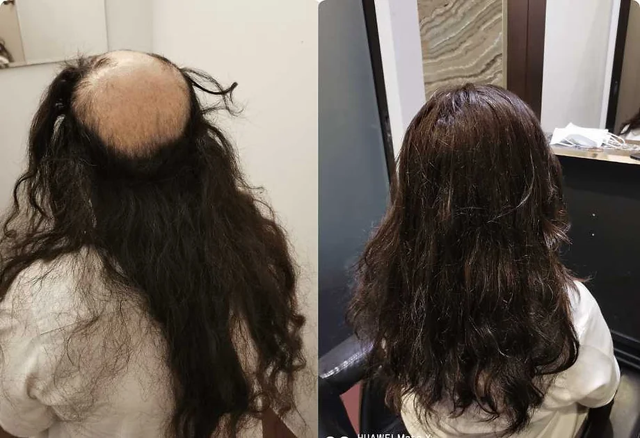Hair Replacement System Singapore Cost